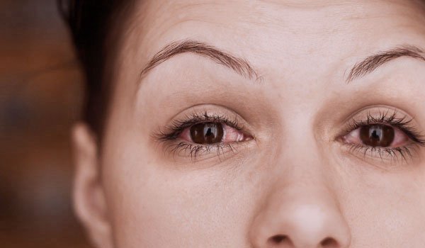 mujer con conjuntivitis en el ojo