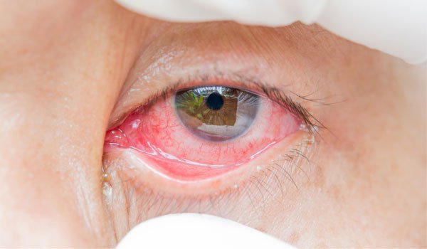 ojo con conjuntivitis folicular