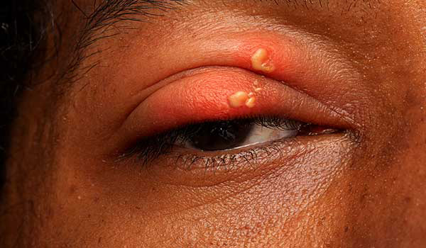 herpes ocular tratamiento