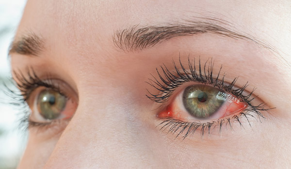 ojos con hiperemia conjuntival