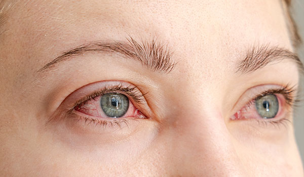 ojo con blefaroconjuntivitis
