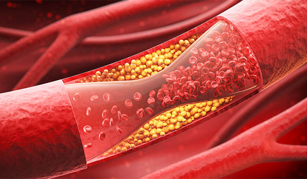 Dislipidemia visi&oacute;n