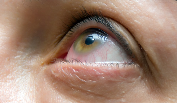 ojo con conjuntivitis lírica