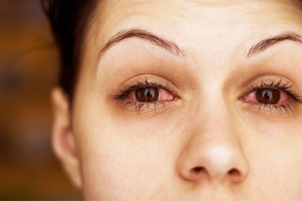 Alergia ocular ojos rojos