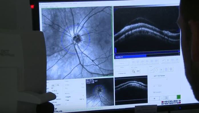 Tomografía de Coherencia Óptica fondo de ojo