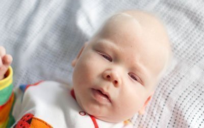 albinismo en bebé