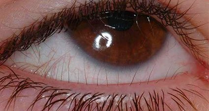 Distiquiasis ojo