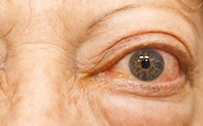 ojo con enfermedad de graves