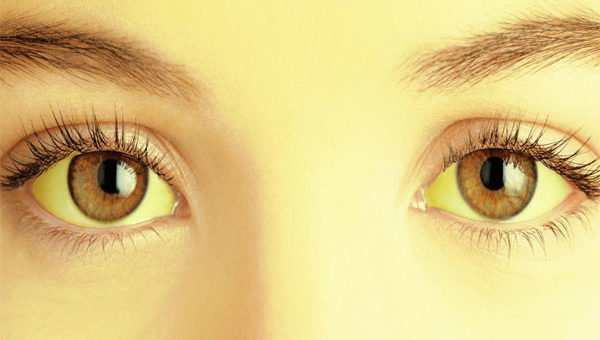 Esclerótica con ojos amarillentos