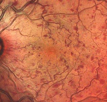 trombosis en la retina